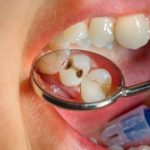 4 Bahan Alami untuk Mengatasi Gigi Berlubang